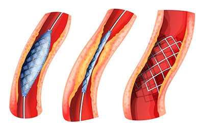 Illustration of a stent used to open blocked artery on a white background