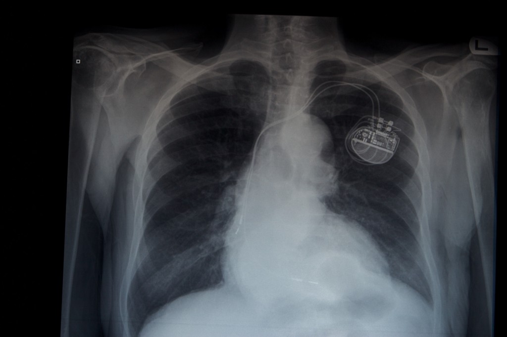 Eighty year old man with a pacemaker